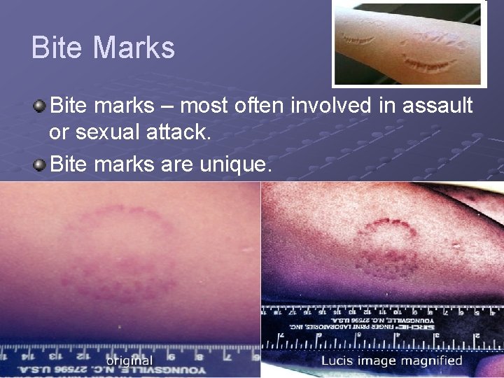Bite Marks Bite marks – most often involved in assault or sexual attack. Bite