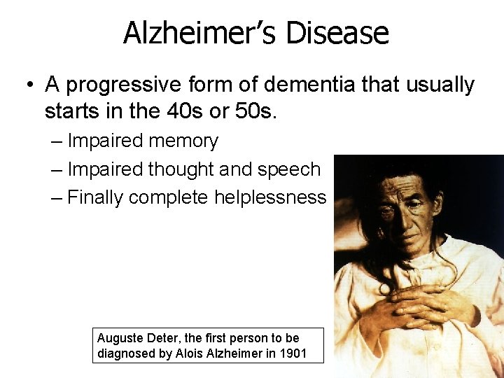Alzheimer’s Disease • A progressive form of dementia that usually starts in the 40 Alzheimer’s Disease • A progressive form of dementia that usually starts in the 40