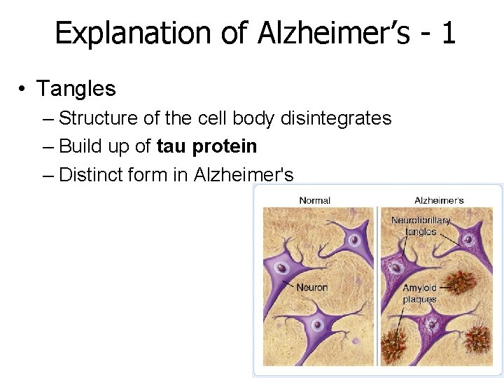 Explanation of Alzheimer’s - 1 • Tangles – Structure of the cell body disintegrates