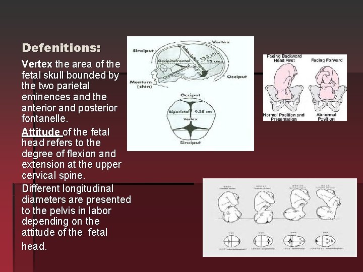 Defenitions: Vertex the area of the fetal skull bounded by the two parietal eminences