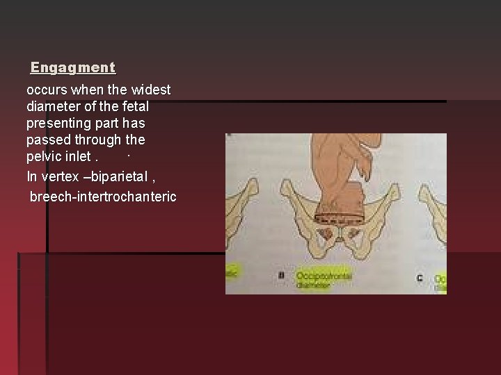 Engagment occurs when the widest diameter of the fetal presenting part has passed through