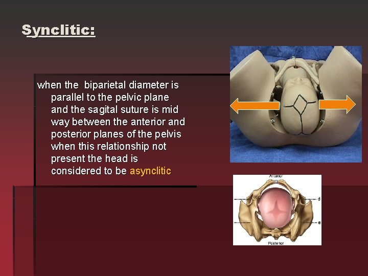 Synclitic: when the biparietal diameter is parallel to the pelvic plane and the sagital