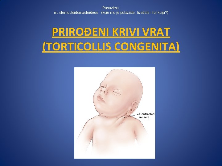 Ponovimo: m. sternocleidomastoideus (koje mu je polazište, hvatište i funkcija? ) PRIROĐENI KRIVI VRAT