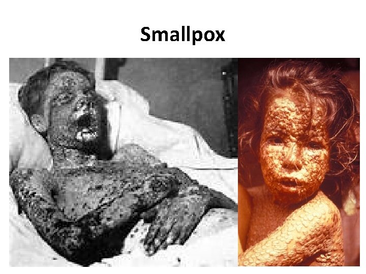 Smallpox 