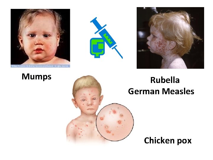 Mumps Rubella German Measles Chicken pox 