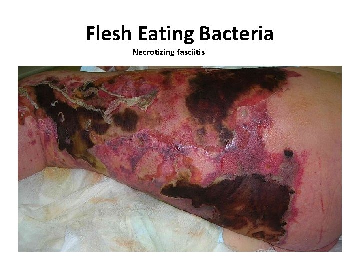 Flesh Eating Bacteria Necrotizing fasciitis 