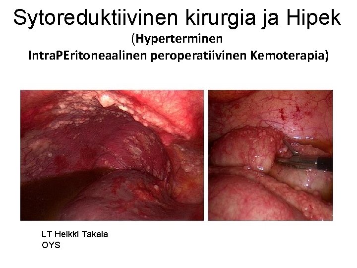 Sytoreduktiivinen kirurgia ja Hipek (Hyperterminen Intra. PEritoneaalinen peroperatiivinen Kemoterapia) LT Heikki Takala OYS Sytoreduktiivinen kirurgia ja Hipek (Hyperterminen Intra. PEritoneaalinen peroperatiivinen Kemoterapia) LT Heikki Takala OYS