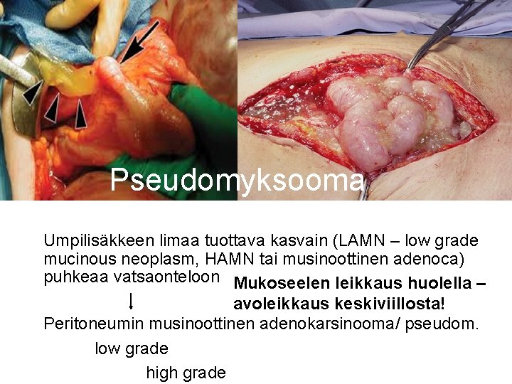 Pseudomyksooma Umpilisäkkeen limaa tuottava kasvain (LAMN – low grade mucinous neoplasm, HAMN tai musinoottinen Pseudomyksooma Umpilisäkkeen limaa tuottava kasvain (LAMN – low grade mucinous neoplasm, HAMN tai musinoottinen