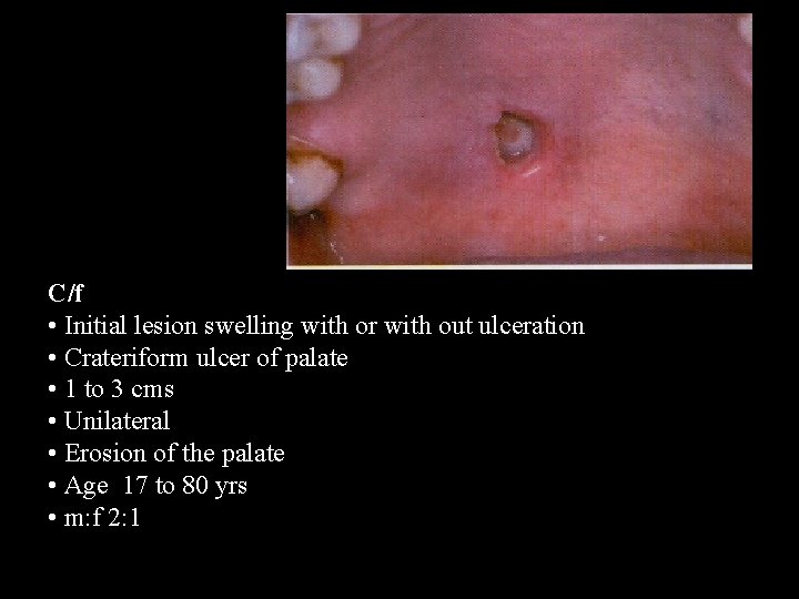 C/f • Initial lesion swelling with or with out ulceration • Crateriform ulcer of