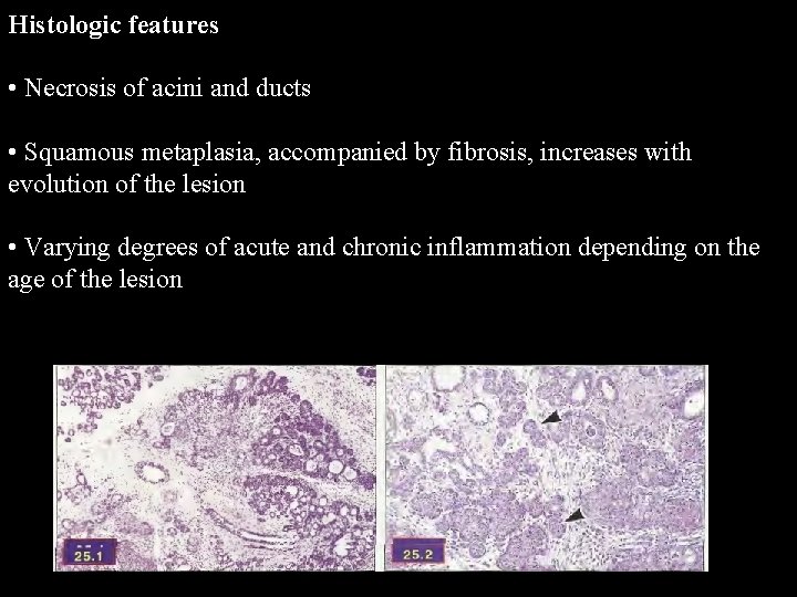 Histologic features • Necrosis of acini and ducts • Squamous metaplasia, accompanied by fibrosis,