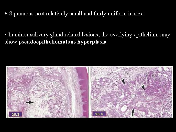  • Squamous nest relatively small and fairly uniform in size • In minor