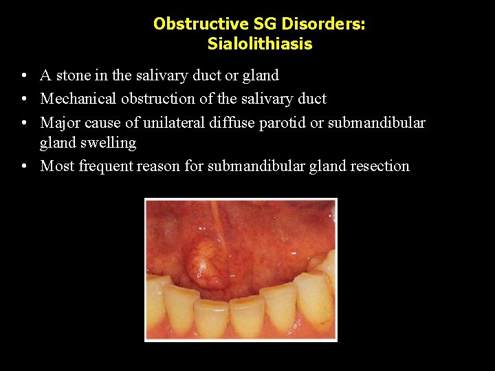 Obstructive SG Disorders: Sialolithiasis • A stone in the salivary duct or gland •