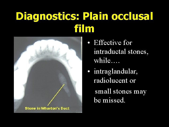 Diagnostics: Plain occlusal film • Effective for intraductal stones, while…. • intraglandular, radiolucent or