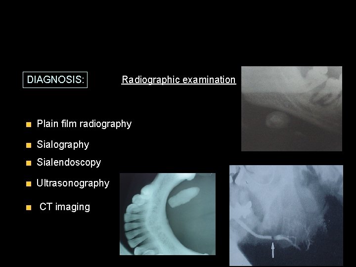 DIAGNOSIS: Radiographic examination Plain film radiography Sialendoscopy Ultrasonography CT imaging 