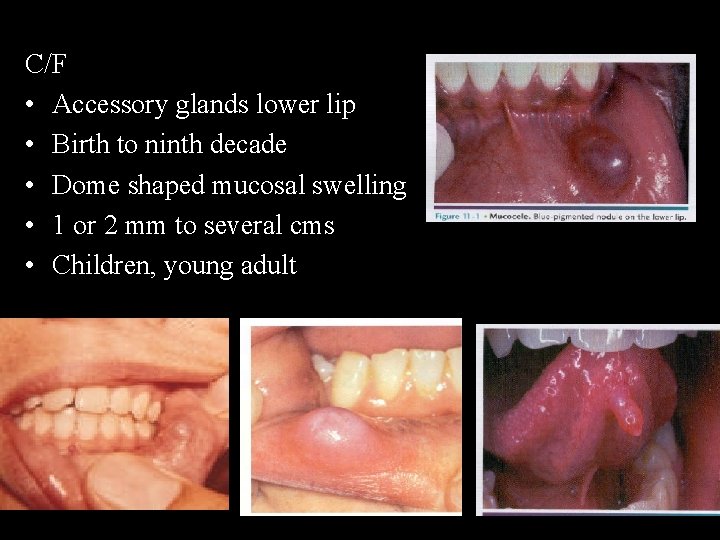 C/F • Accessory glands lower lip • Birth to ninth decade • Dome shaped