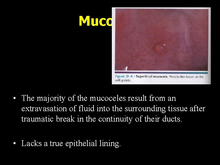 Mucocele • The majority of the mucoceles result from an extravasation of fluid into