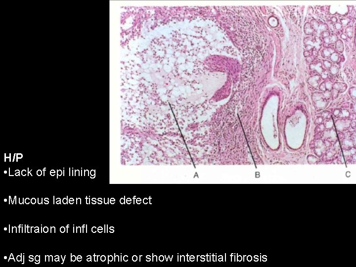 H/P • Lack of epi lining • Mucous laden tissue defect • Infiltraion of