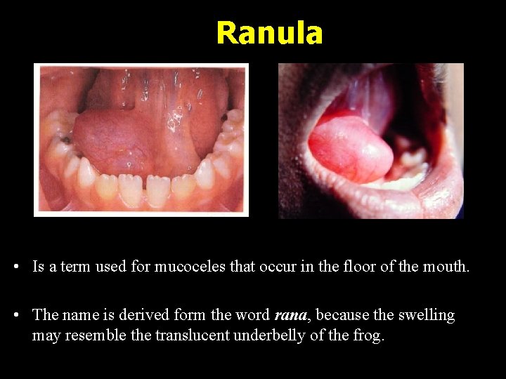 Ranula • Is a term used for mucoceles that occur in the floor of