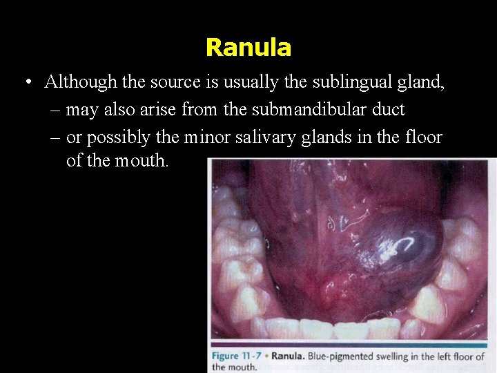 Ranula • Although the source is usually the sublingual gland, – may also arise