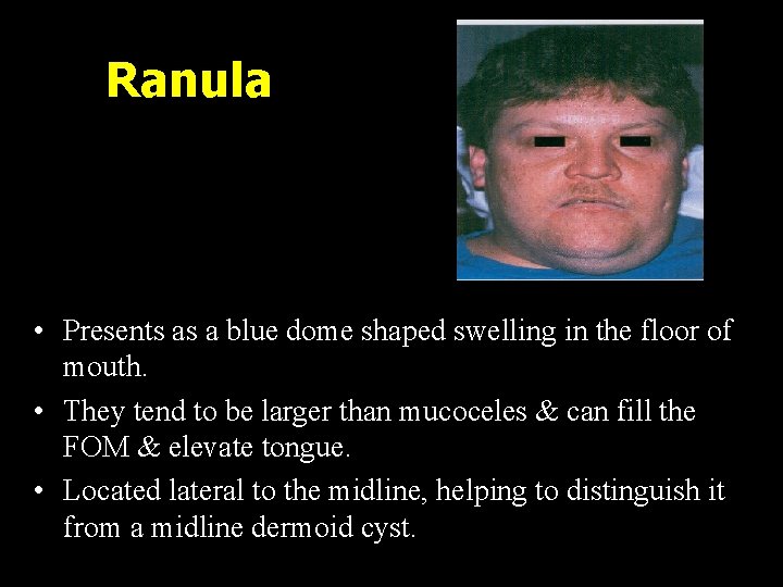 Ranula • Presents as a blue dome shaped swelling in the floor of mouth.