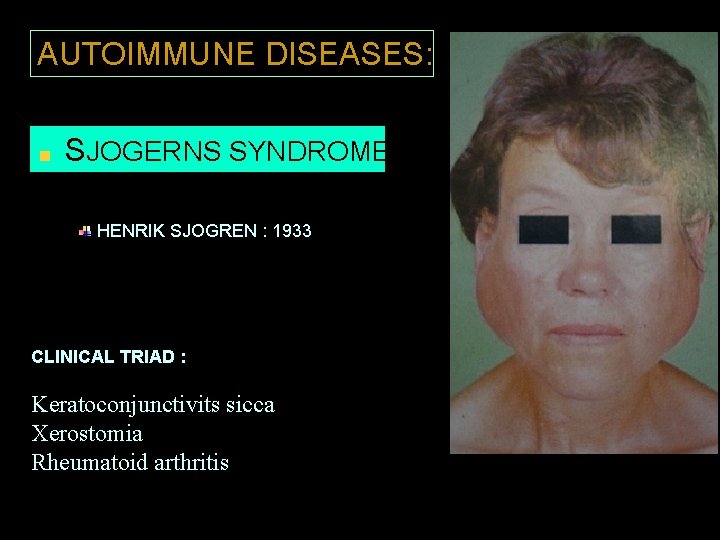 AUTOIMMUNE DISEASES: SJOGERNS SYNDROME HENRIK SJOGREN : 1933 CLINICAL TRIAD : Keratoconjunctivits sicca Xerostomia