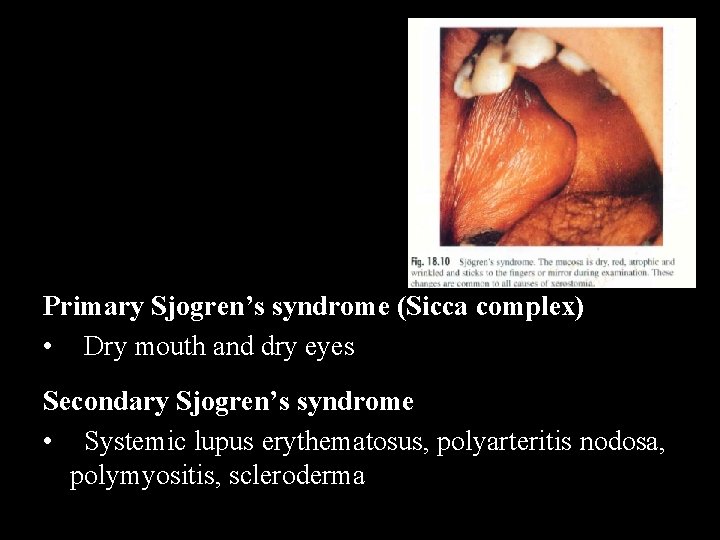 Primary Sjogren’s syndrome (Sicca complex) • Dry mouth and dry eyes Secondary Sjogren’s syndrome