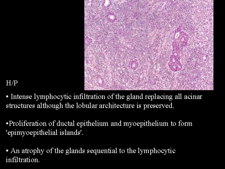 H/P • Intense lymphocytic infiltration of the gland replacing all acinar structures although the