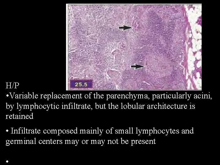 H/P • Variable replacement of the parenchyma, particularly acini, by lymphocytic infiltrate, but the