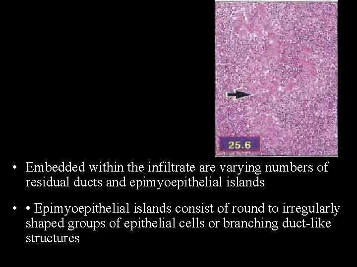  • Embedded within the infiltrate are varying numbers of residual ducts and epimyoepithelial