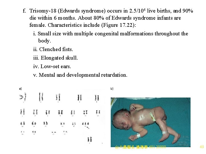 f. Trisomy-18 (Edwards syndrome) occurs in 2. 5/104 live births, and 90% die within f. Trisomy-18 (Edwards syndrome) occurs in 2. 5/104 live births, and 90% die within