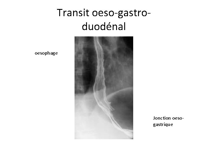 Transit oeso-gastroduodénal oesophage Jonction oesogastrique 
