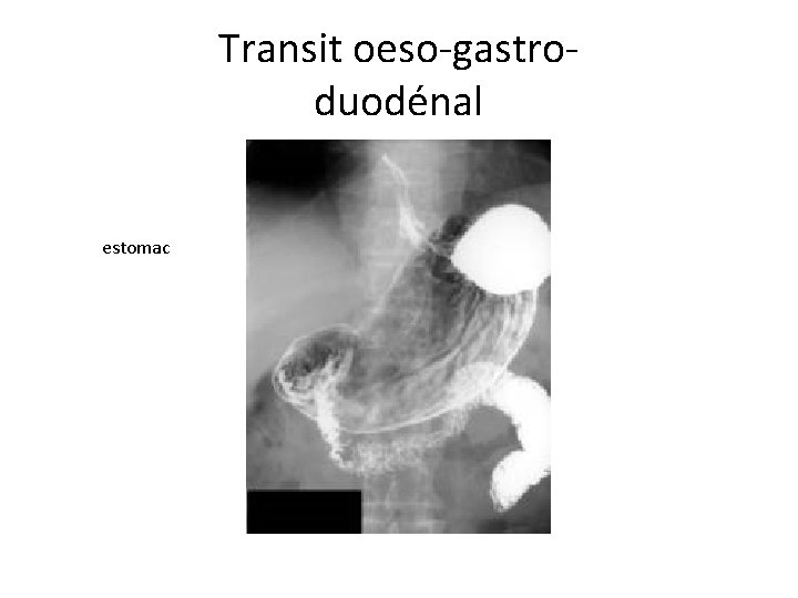 Transit oeso-gastroduodénal estomac 