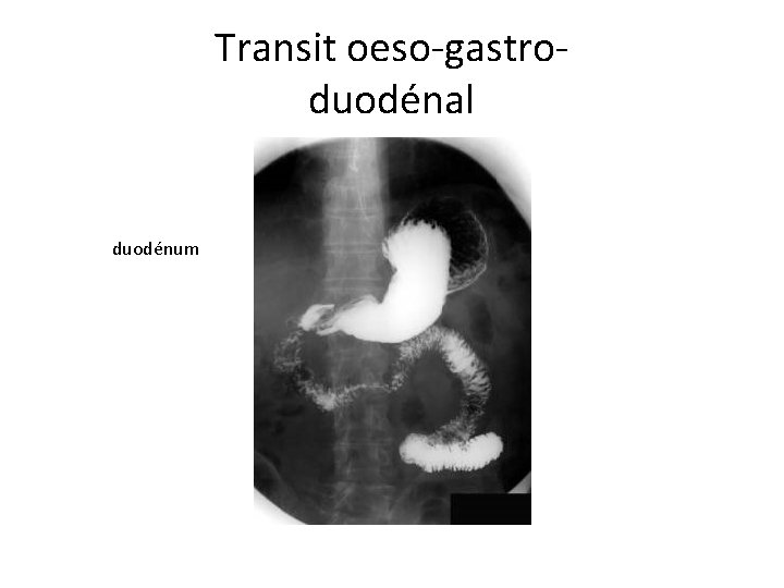 Transit oeso-gastroduodénal duodénum 