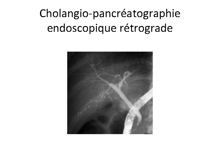 Cholangio-pancréatographie endoscopique rétrograde 