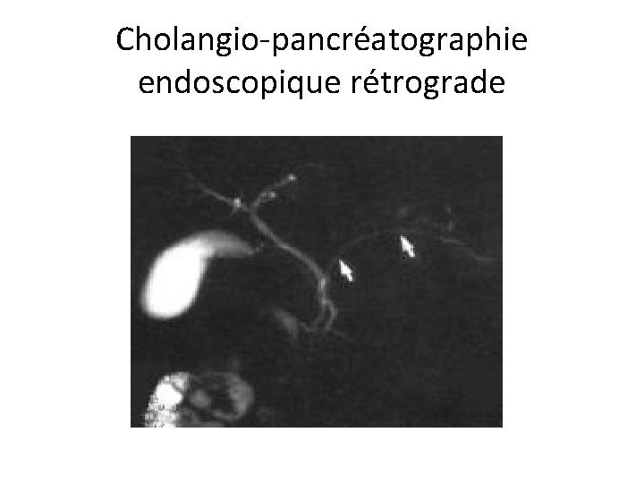 Cholangio-pancréatographie endoscopique rétrograde 