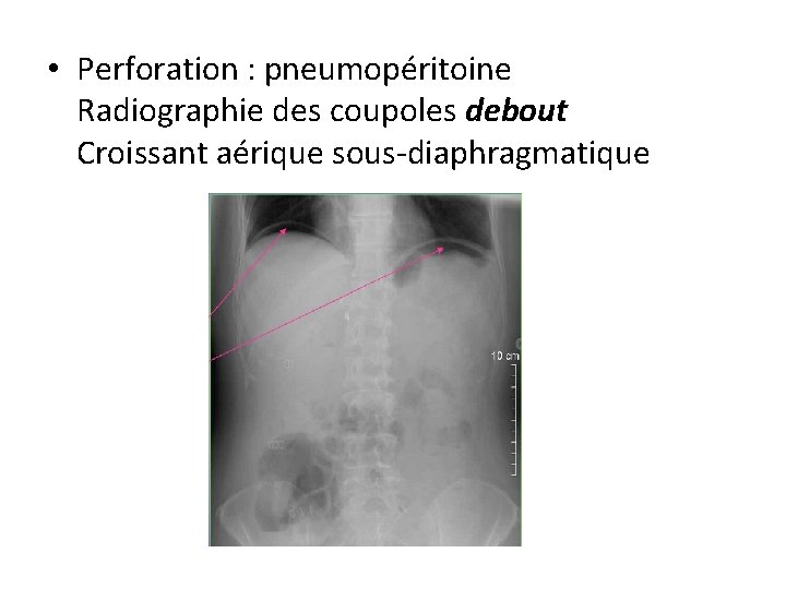  • Perforation : pneumopéritoine Radiographie des coupoles debout Croissant aérique sous-diaphragmatique 