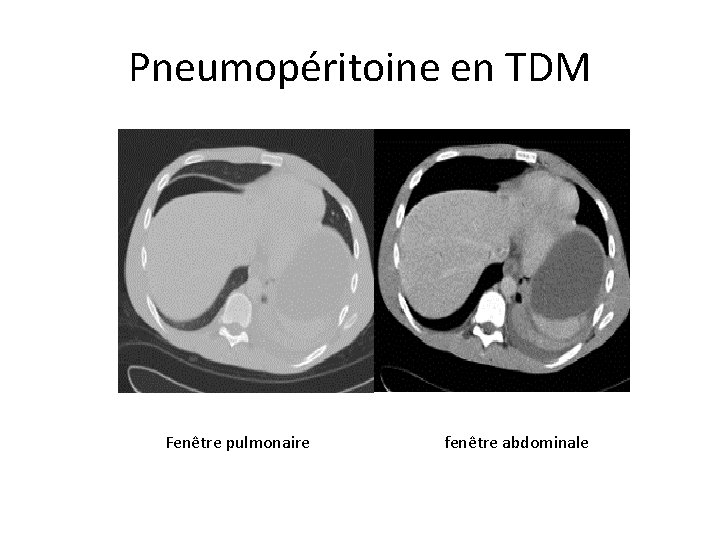 Pneumopéritoine en TDM Fenêtre pulmonaire fenêtre abdominale 