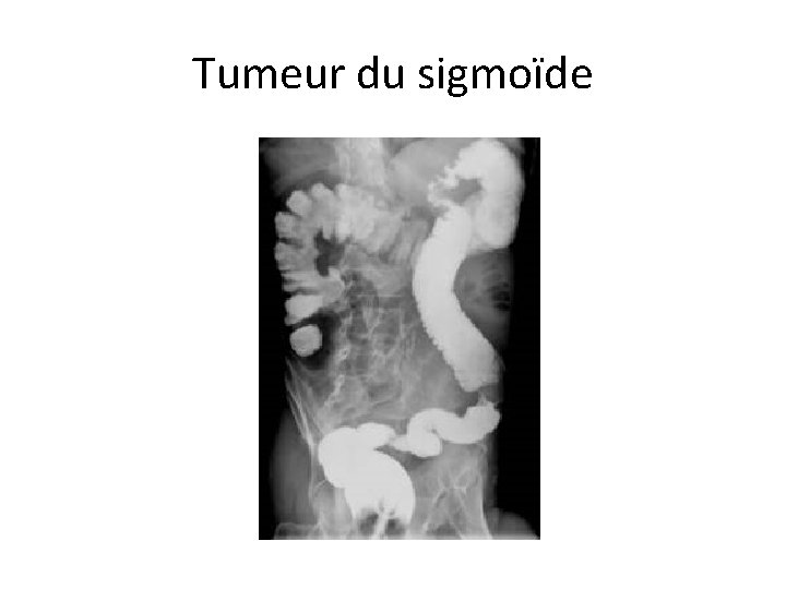 Tumeur du sigmoïde 