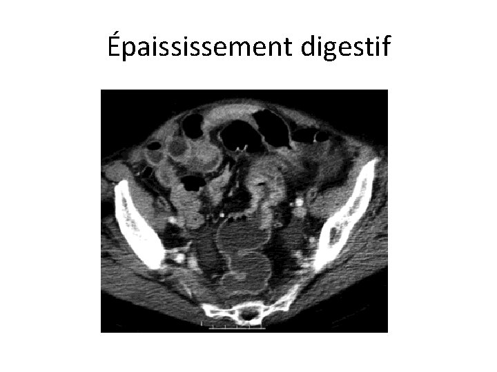 Épaississement digestif 