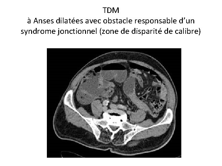 TDM à Anses dilatées avec obstacle responsable d’un syndrome jonctionnel (zone de disparité de