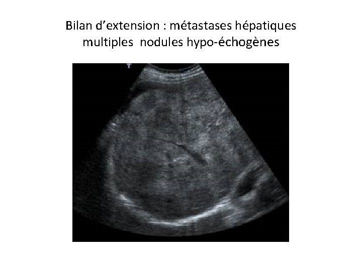 Bilan d’extension : métastases hépatiques multiples nodules hypo-échogènes 