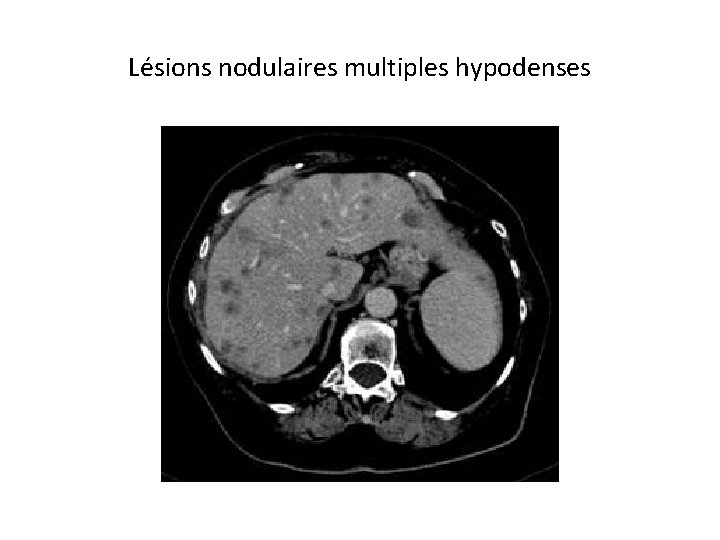 Lésions nodulaires multiples hypodenses 