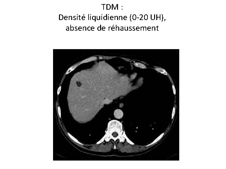 TDM : Densité liquidienne (0 -20 UH), absence de réhaussement 