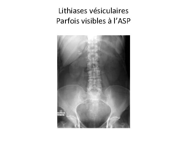Lithiases vésiculaires Parfois visibles à l’ASP 