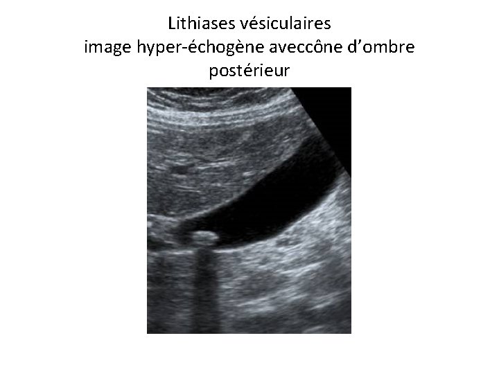 Lithiases vésiculaires image hyper-échogène aveccône d’ombre postérieur 