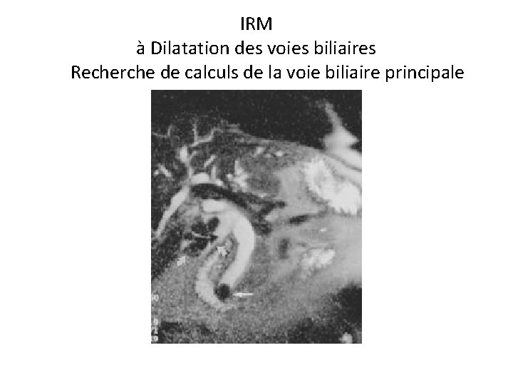 IRM à Dilatation des voies biliaires Recherche de calculs de la voie biliaire principale