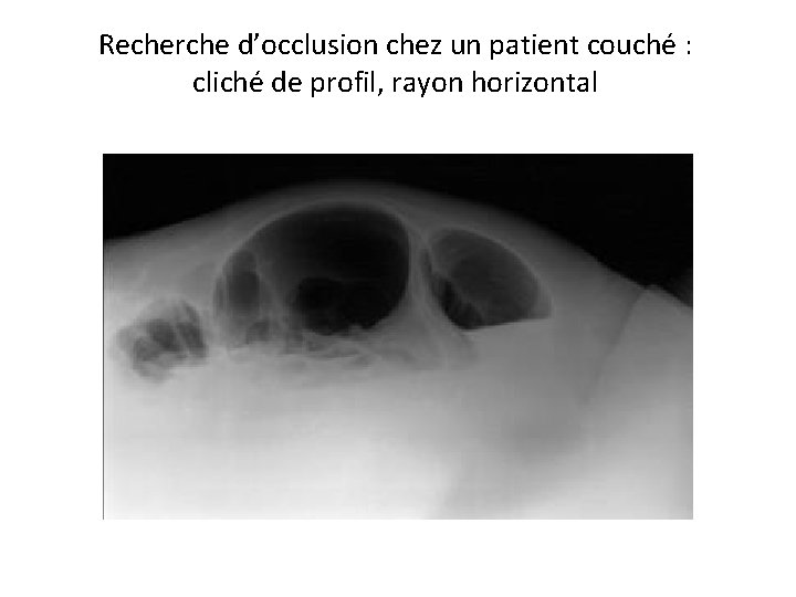 Recherche d’occlusion chez un patient couché : cliché de profil, rayon horizontal 