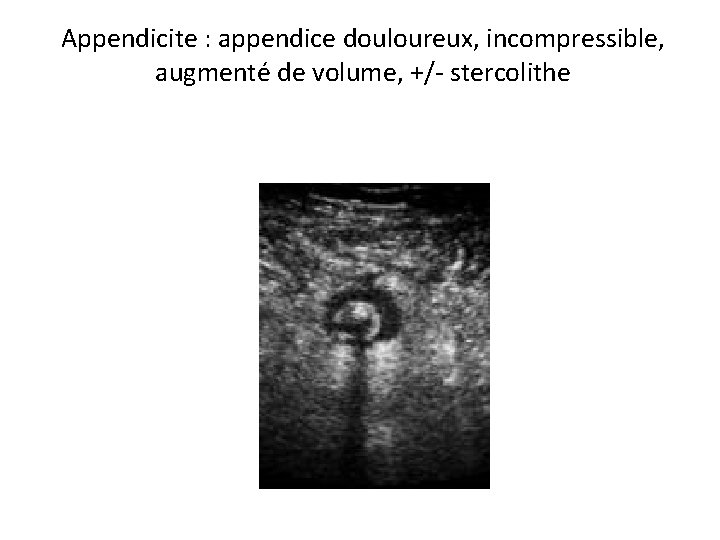 Appendicite : appendice douloureux, incompressible, augmenté de volume, +/- stercolithe 