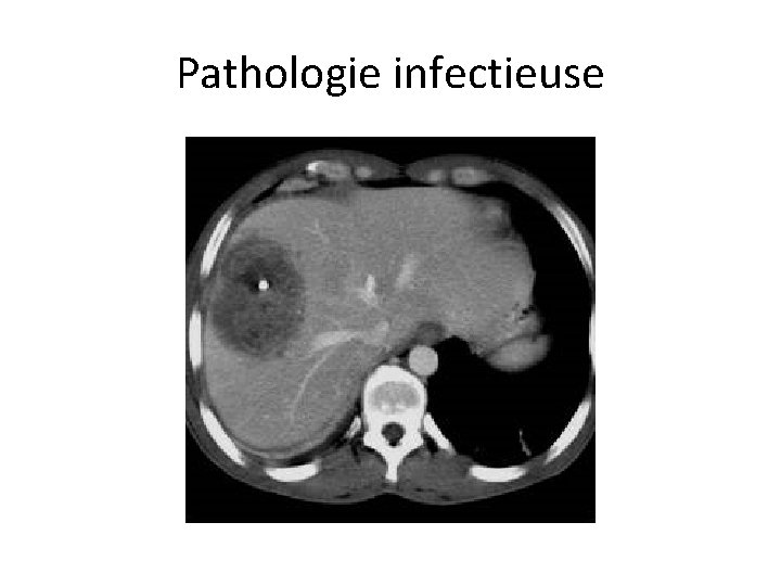 Pathologie infectieuse 