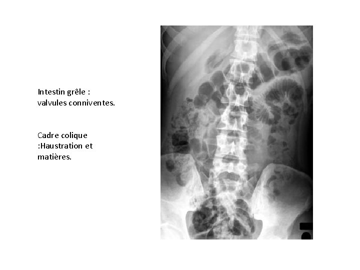 Intestin grêle : valvules conniventes. Cadre colique : Haustration et matières. 